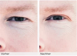 Augenlid-Liftingstripes Gr. M -hochwertige Pflegeprodukte MAM 3810471 SHOP IMAGE 1.4